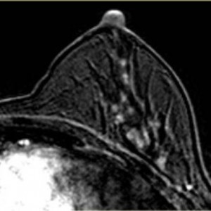 Что показывает МРТ молочной железы
