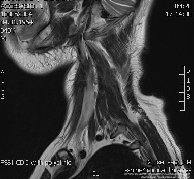 Что показывает МРТ мягких тканей шеи?
